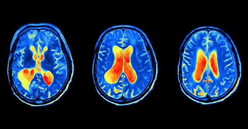 fMRI(강력한 자성체를 이용하는 뇌스캔의 일종으로, 뇌에 있는 작은 혈관 속 철 성분을 감지함으로써 뇌의 움직임을 볼 수 있다)